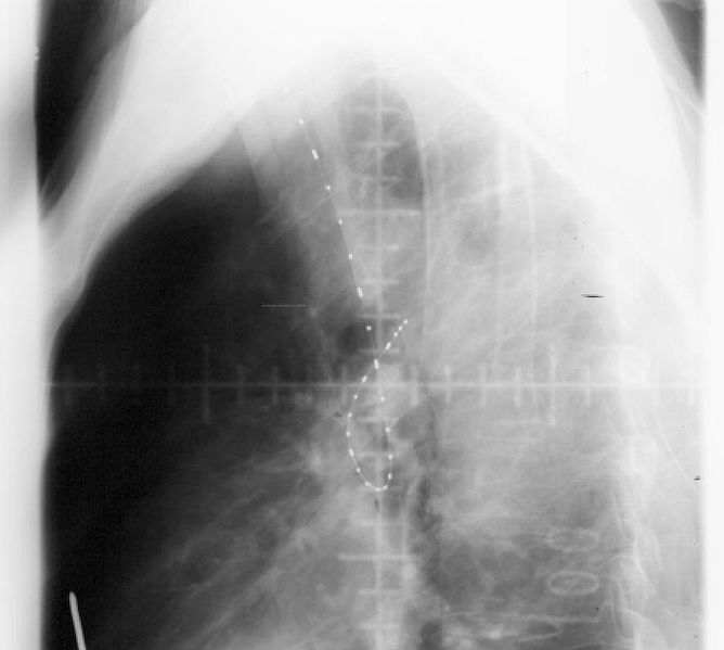 X-ray of person's body undergoing endobronchial radiation therapy